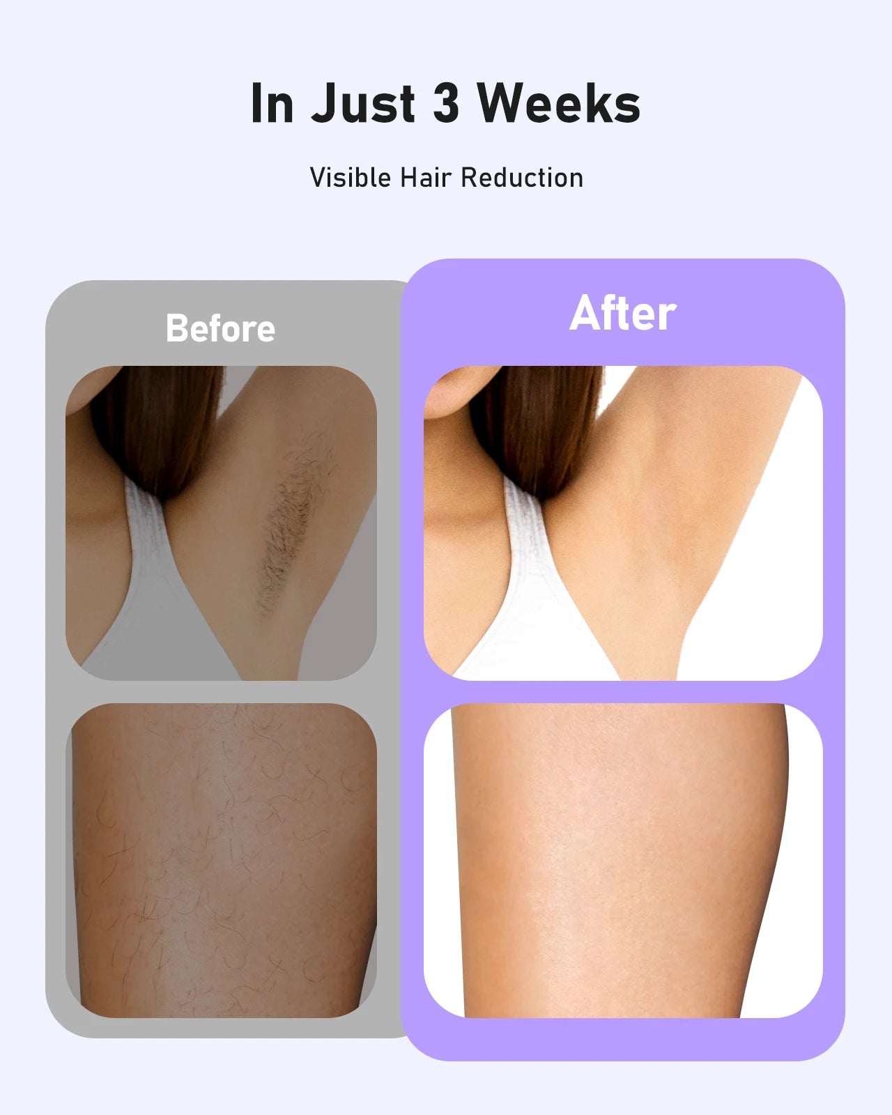 990000 Flashes Laser Hair Removal for Women and Men Body Bikini and Facial Areas Painless Permanent HairRemoval IPL Hair Removal